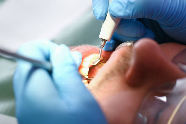 Best Emergency Treatment for Dental Infections or Abscesses in Kirkland, WA